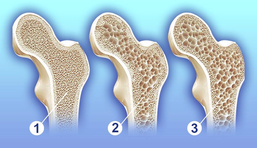 Osteoporoz: Sessiz Tehlikeyi Anlamak ve Kemik Sağlığını Korumak