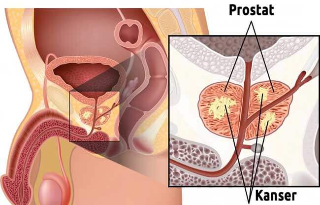 Prostat Kanseri: Kontrolü Elinizde Tutun 