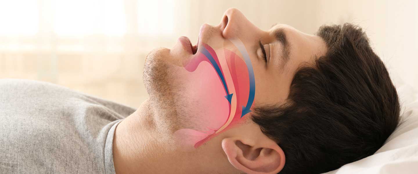 Horlama ve Uyku Apnesi: Uykunuzun Kalitesini Geri Kazanın