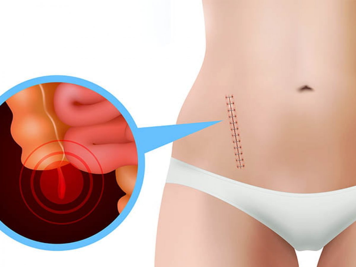 Karın Ağrısını Hafife Almayın: Apendektomi (Apandisit Ameliyatı) Hakkında Her Şey