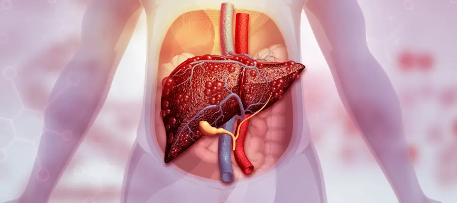 Karaciğer Yağlanması Hakkında Bilmeniz Gerekenler